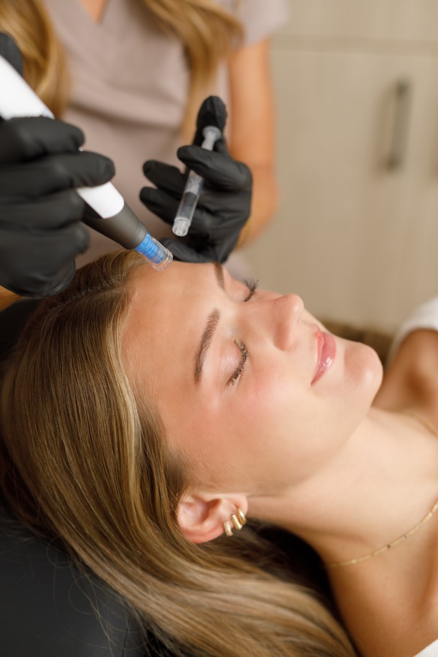A microneedling pen being used on a client's forehead